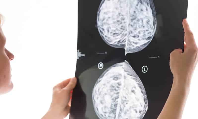 Brustkrebs-Mammographie-Männer