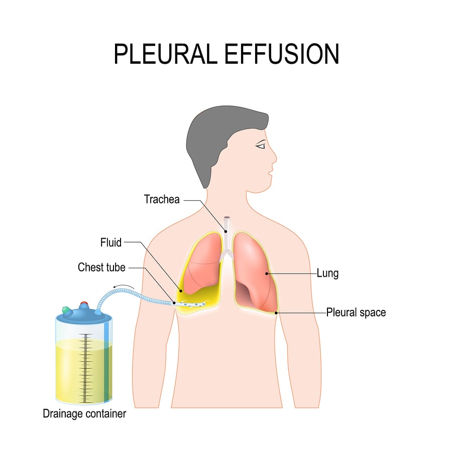 Pleural Effusion fluid on lungs